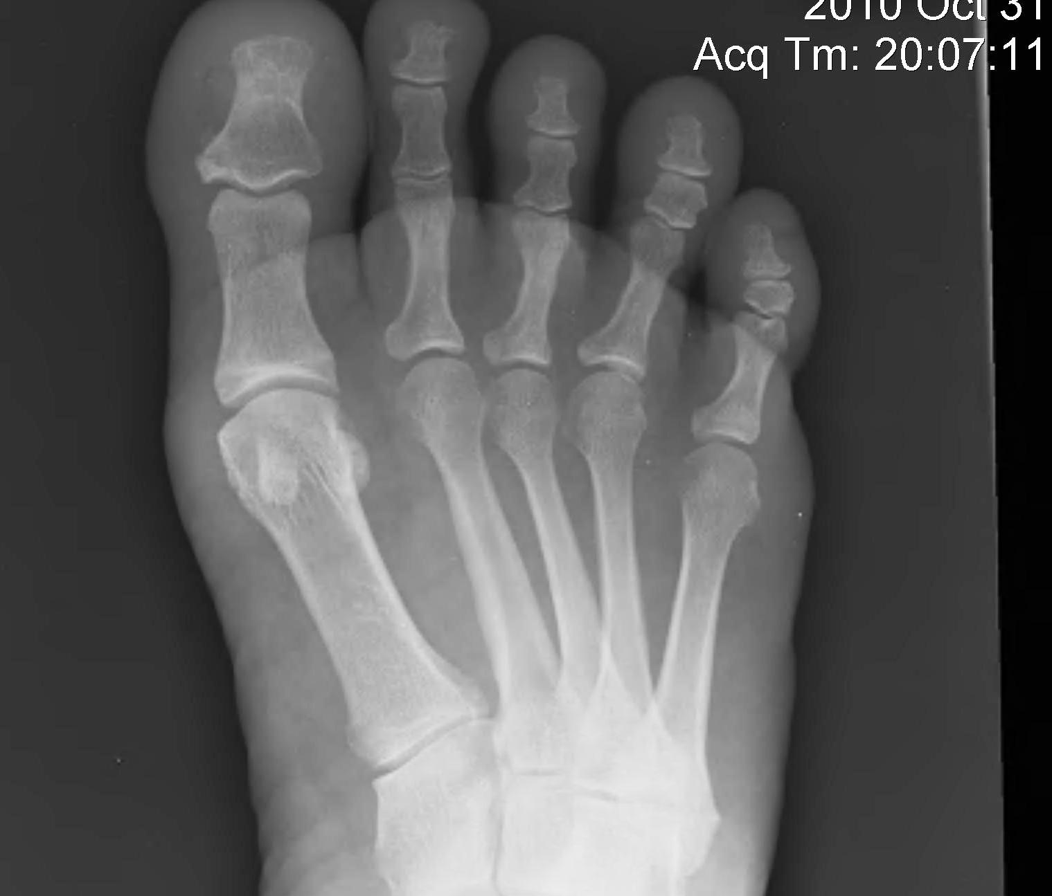 Metatarsalgia Splayed Foot